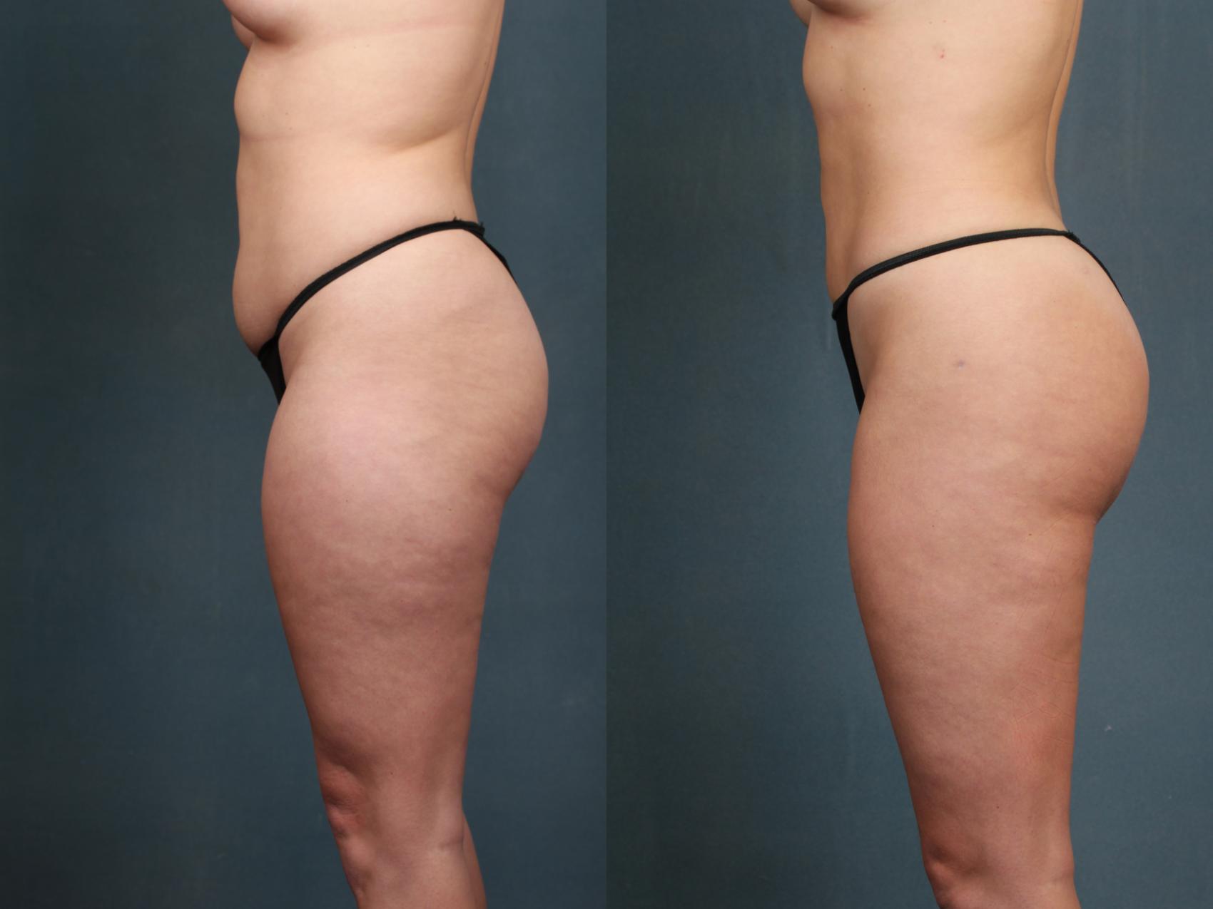 CaloAesthetics Brazilian Butt Lift before and after photo