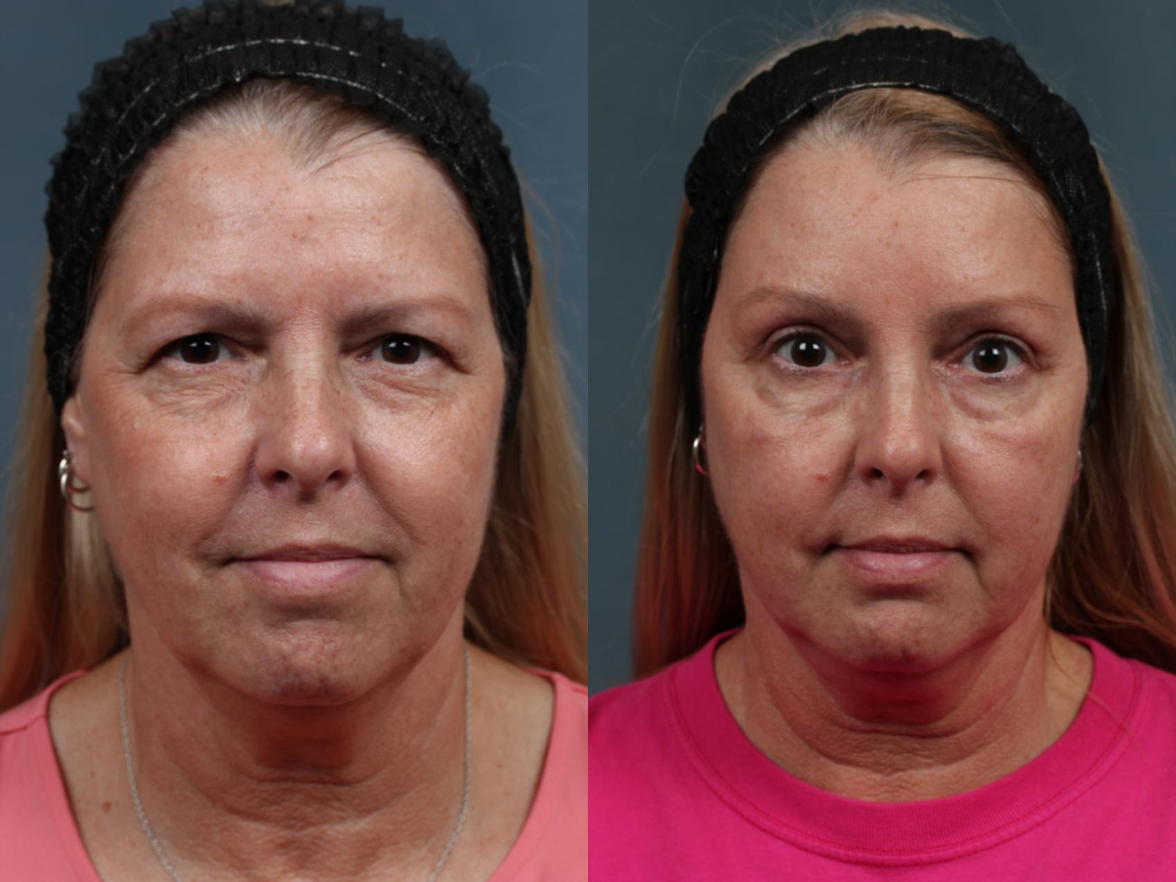 Brow Forehead Lift Before After Photo Gallery Louisville Ky Caloaesthetics Plastic Surgery Center