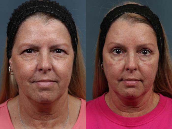 Before & After Brow/Forehead Lift Case 499 View #1 View in Louisville & Lexington, KY