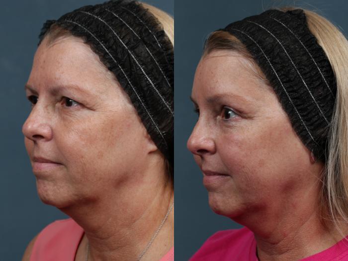 Brow/Forehead Lift Case 499 Before & After View #2 | Louisville, KY | CaloSpa® Rejuvenation Center