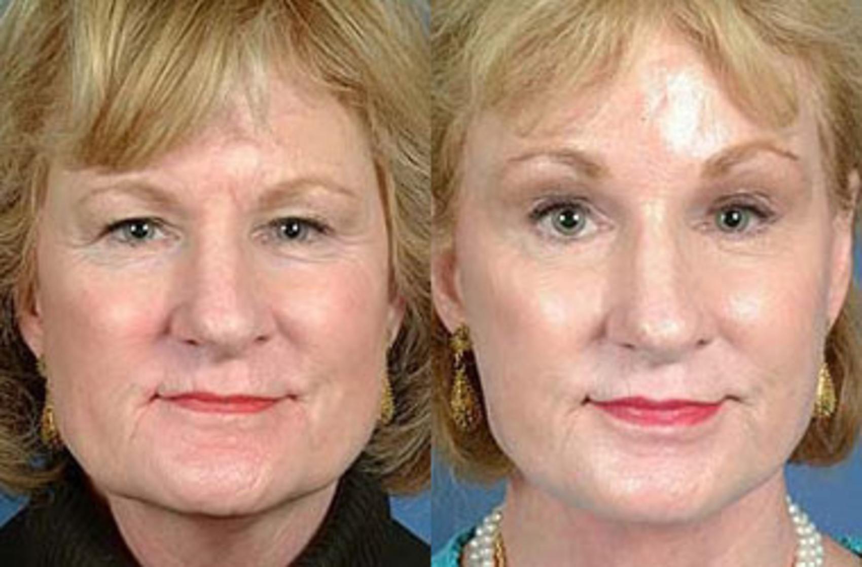 Before & After Brow/Forehead Lift Case 70 View #1 View in Louisville & Lexington, KY
