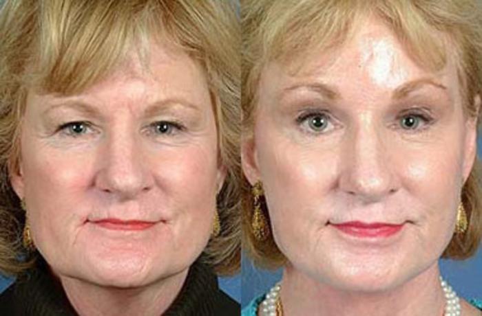 Before & After Brow/Forehead Lift Case 70 View #1 View in Louisville & Lexington, KY