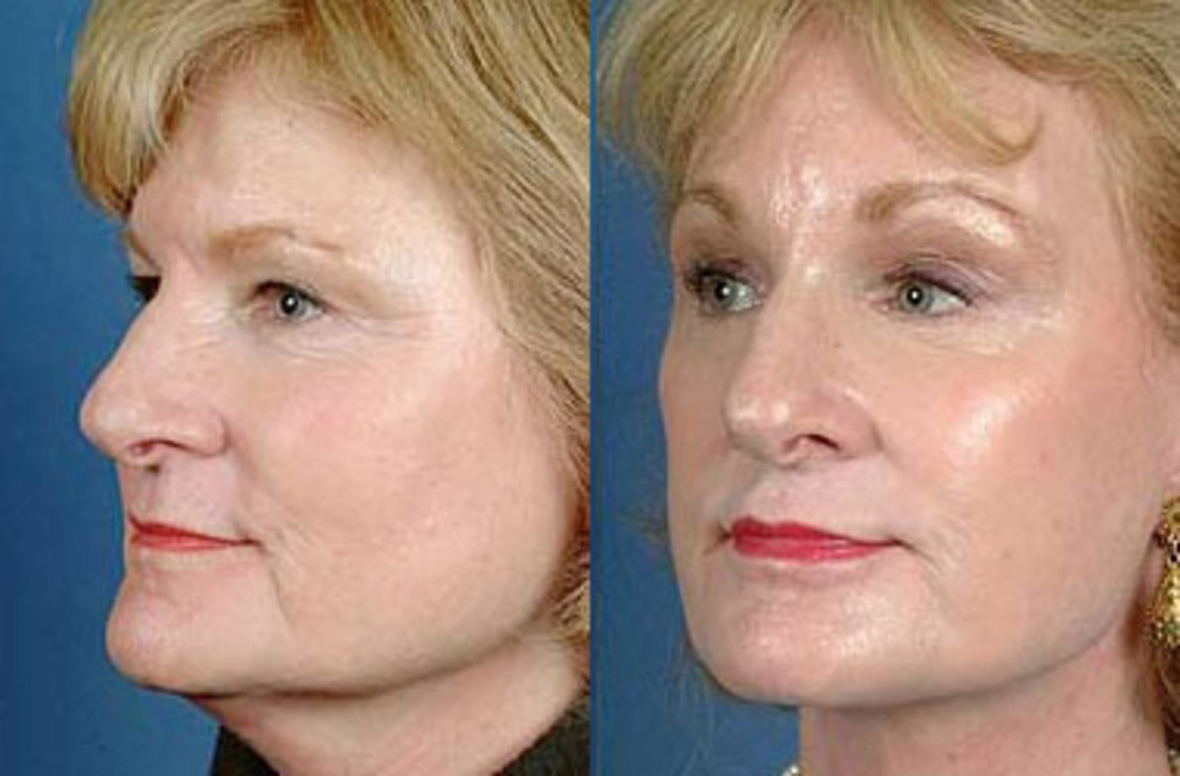 Before & After Brow/Forehead Lift Case 70 View #2 View in Louisville & Lexington, KY