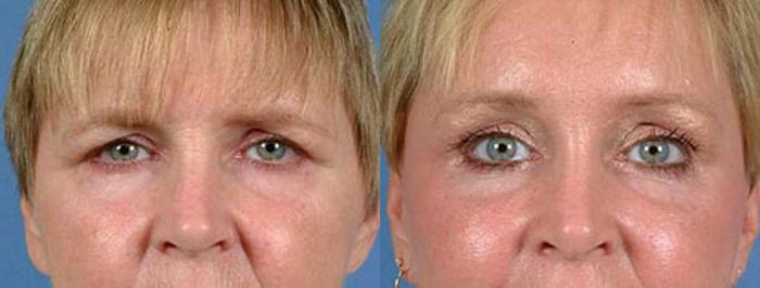 Before & After Brow/Forehead Lift Case 73 View #1 View in Louisville & Lexington, KY