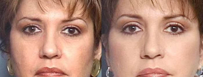 Before & After Brow/Forehead Lift Case 74 View #1 View in Louisville & Lexington, KY