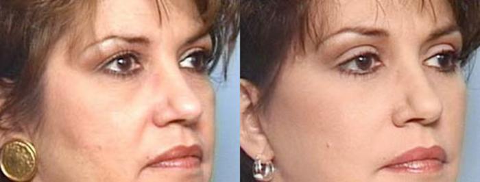 Before & After Brow/Forehead Lift Case 74 View #2 View in Louisville & Lexington, KY