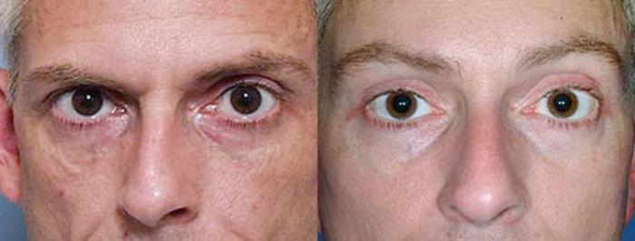 Before & After Brow/Forehead Lift Case 75 View #1 View in Louisville & Lexington, KY