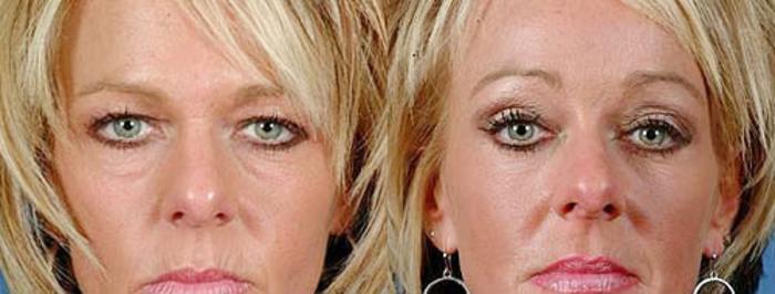 Before & After Brow/Forehead Lift Case 77 View #1 View in Louisville & Lexington, KY