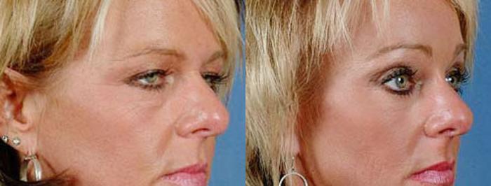 Before & After Brow/Forehead Lift Case 77 View #3 View in Louisville & Lexington, KY