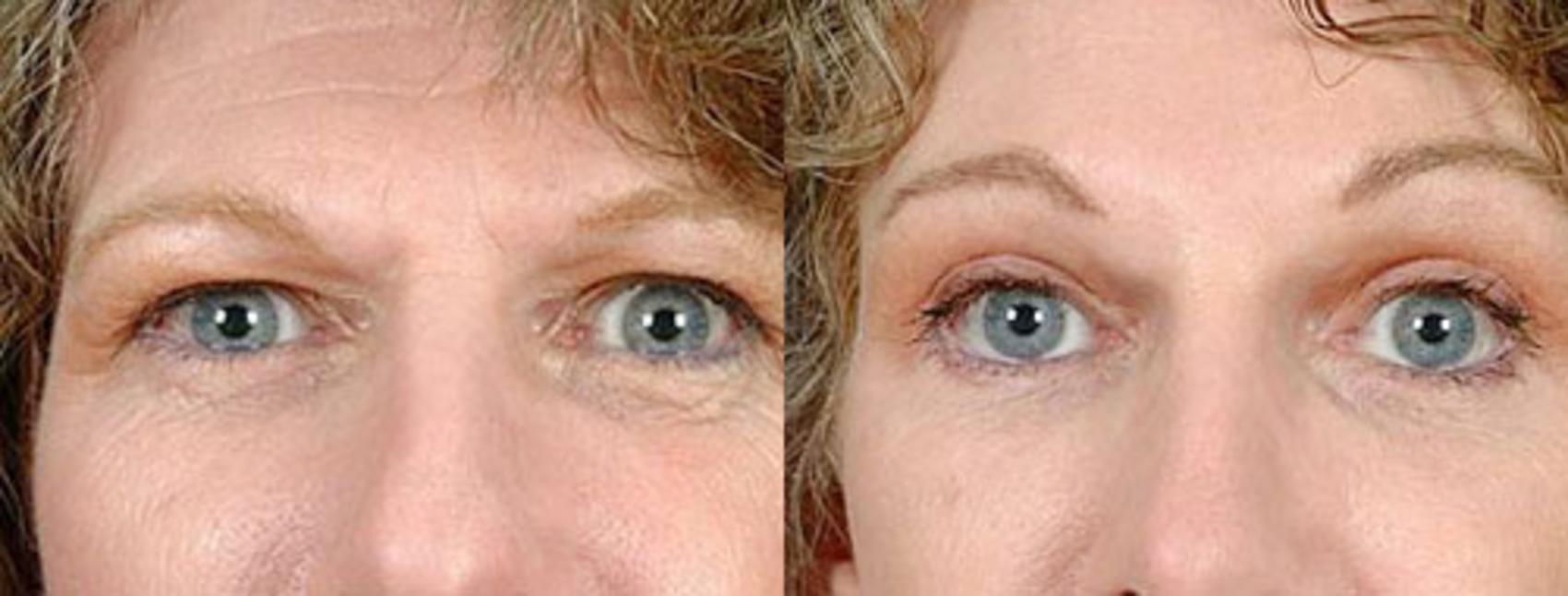 Before & After Brow/Forehead Lift Case 78 View #1 View in Louisville & Lexington, KY