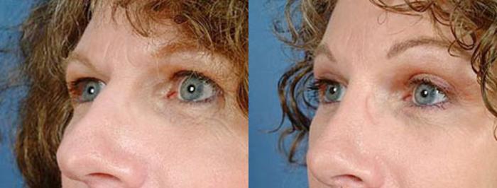 Before & After Brow/Forehead Lift Case 78 View #2 View in Louisville & Lexington, KY