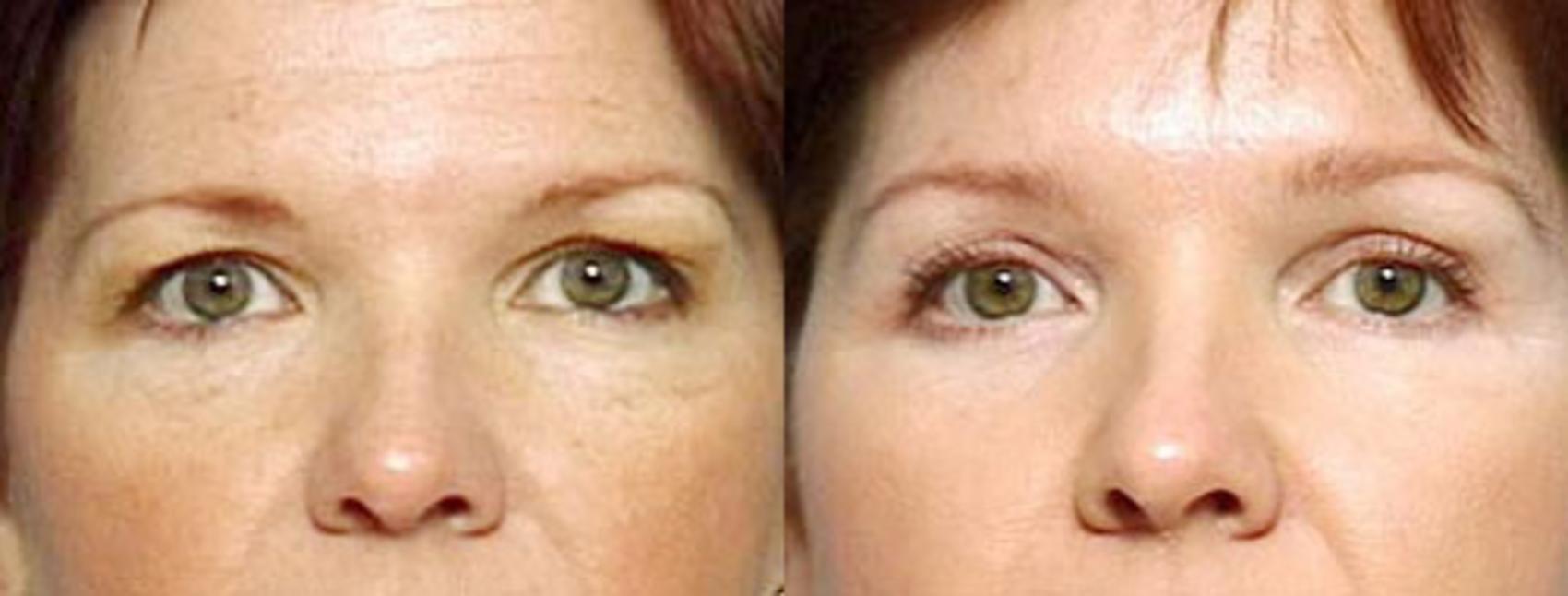 Brow/Forehead Lift Case 79 Before & After View #1 | Louisville, KY | CaloSpa® Rejuvenation Center