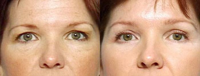 Before & After Brow/Forehead Lift Case 79 View #1 View in Louisville & Lexington, KY