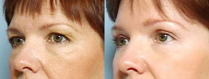 Before & After Brow/Forehead Lift Case 79 View #2 View in Louisville & Lexington, KY