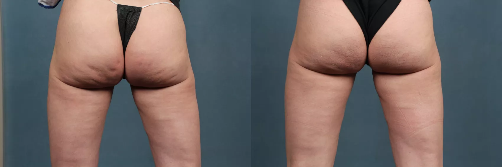 Cellulite Treatment before and after 4 weeks! Incredible