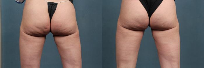 Cellulite Treatments Case 264 Before & After View #1 | Louisville, KY | CaloSpa® Rejuvenation Center