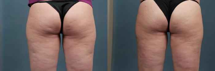 Cellulite Treatments Case 265 Before & After View #1 | Louisville, KY | CaloSpa® Rejuvenation Center