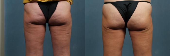 Cellulite Treatments Case 267 Before & After View #1 | Louisville, KY | CaloSpa® Rejuvenation Center