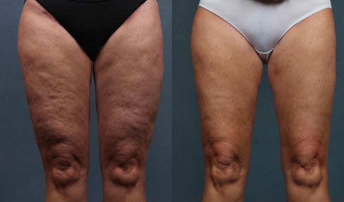 Before & After Cellulite Treatments Case 613 Front View in Louisville & Lexington, KY