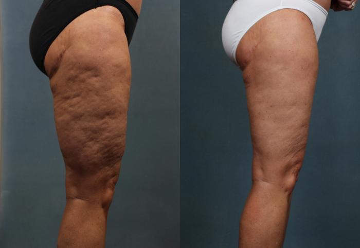 Cellulite Treatments Before & After Photos Patient 613 | Louisville, KY |  CaloSpa® Rejuvenation Center