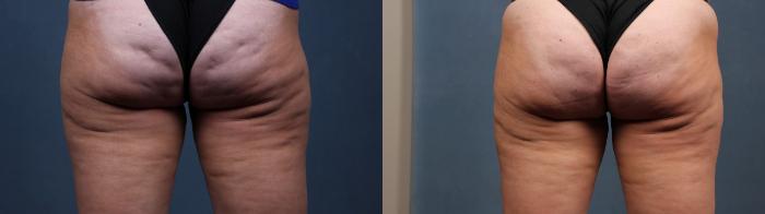 Cellulite Treatments Case 615 Before & After Back | Louisville, KY | CaloSpa® Rejuvenation Center