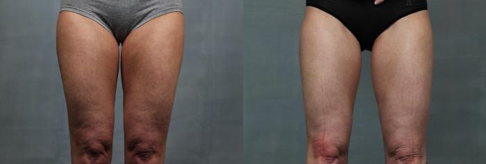 Cellulite Treatments Case 616 Before & After Front | Louisville, KY | CaloSpa® Rejuvenation Center