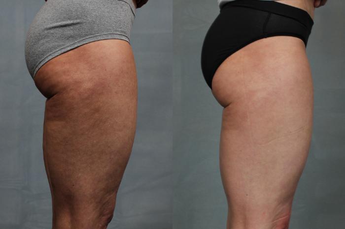 Before & After Cellulite Treatments Case 616 Right Side View in Louisville & Lexington, KY