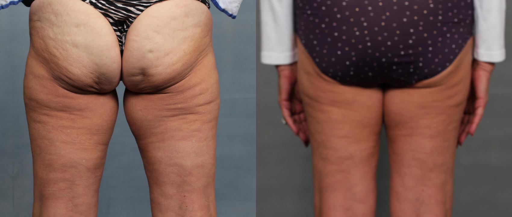 Before & After Cellulite Treatments Case 617 Back View in Louisville & Lexington, KY