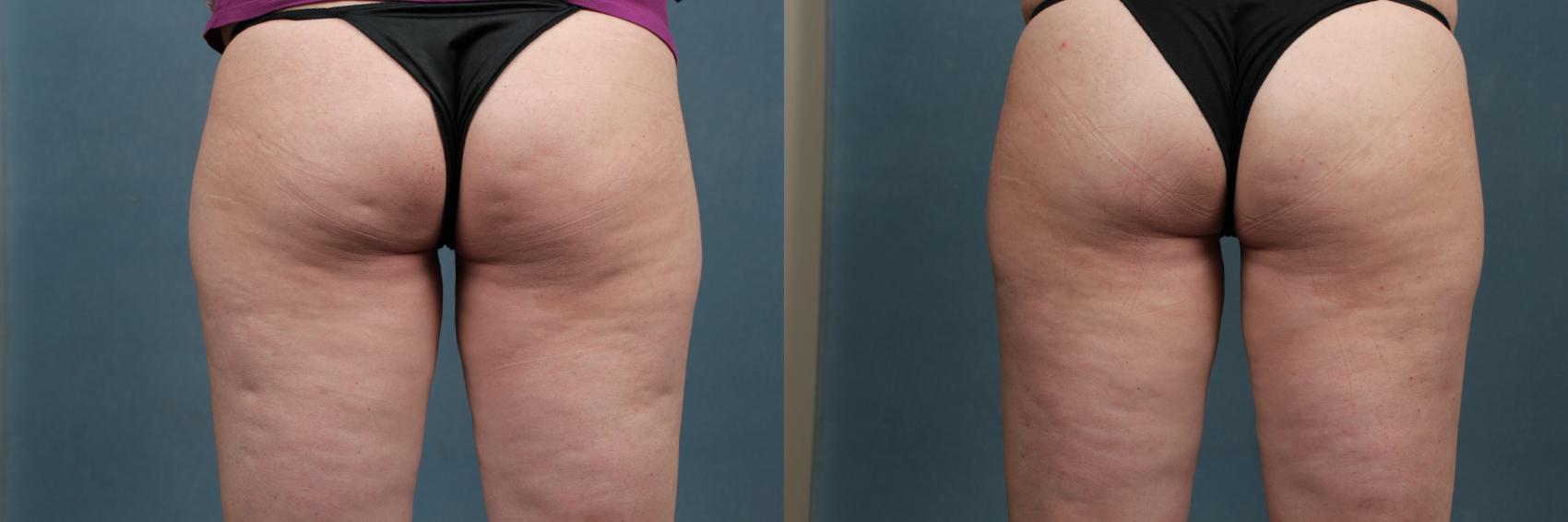 Before & After Cellulite Treatments Case 618 Back View in Louisville, KY