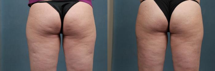 Before & After Cellulite Treatments Case 618 Back View in Louisville & Lexington, KY