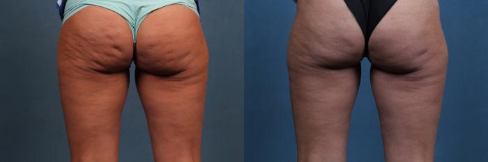 Before & After Cellulite Treatments Case 619 Back View in Louisville & Lexington, KY