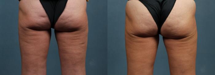Cellulite Treatments Case 620 Before & After Back | Louisville, KY | CaloSpa® Rejuvenation Center