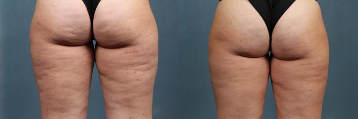 Before & After Cellulite Treatments Case 621 Back View in Louisville & Lexington, KY