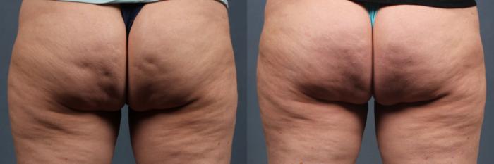 Cellulite Treatments Before & After Photos Patient 264, Louisville &  Lexington, KY
