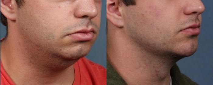 Before & After Chin Augmentation Case 723 Right Oblique View in Louisville & Lexington, KY
