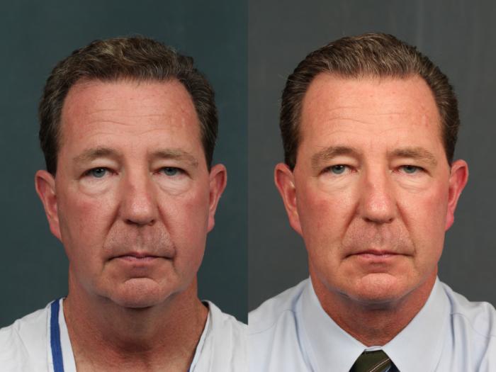 Before & After Chin Augmentation Case 730 Front View in Louisville & Lexington, KY