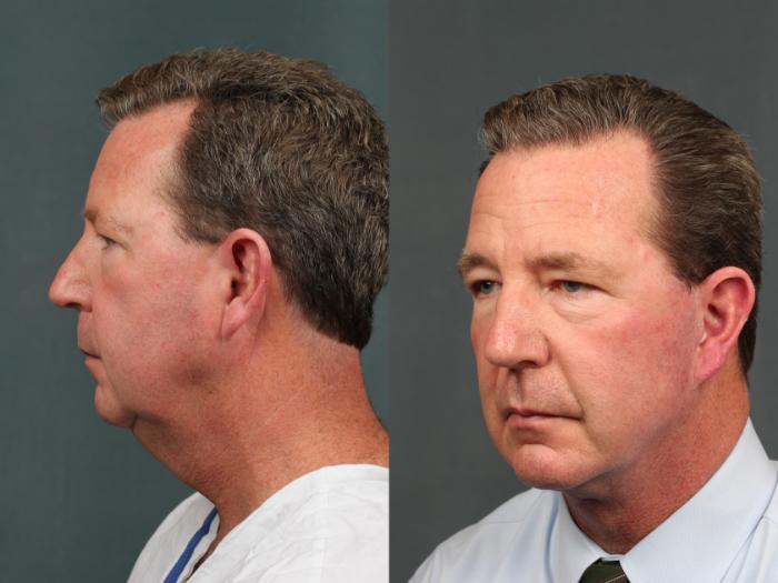 Before & After Chin Augmentation Case 730 Left Oblique View in Louisville & Lexington, KY