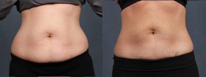Before & After CoolSculpting Case 652 Front View in Louisville, KY