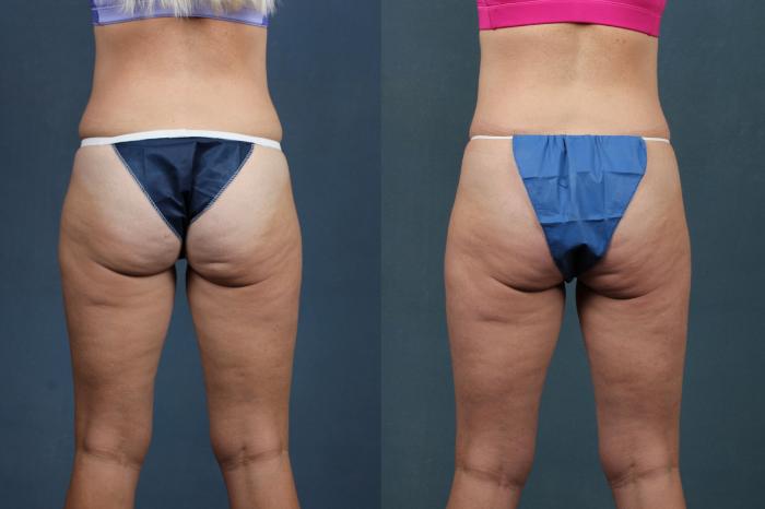 Before & After CoolSculpting Case 654 Back View in Louisville, KY