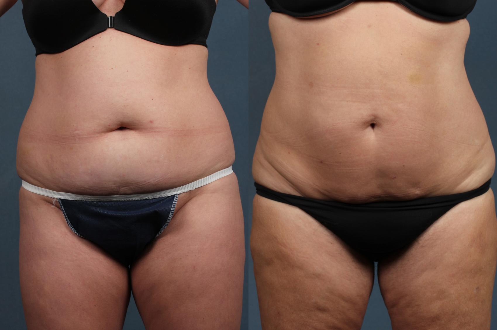 Before & After CoolSculpting Case 655 Front View in Louisville & Lexington, KY