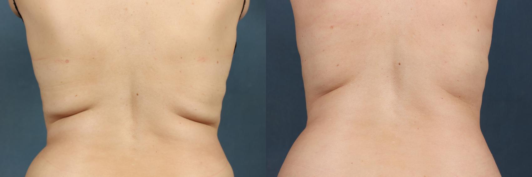 Before & After CoolSculpting Case 656 Back View in Louisville & Lexington, KY