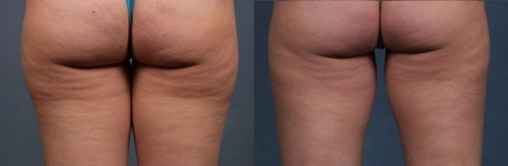 Before & After CoolSculpting Case 658 Back View in Louisville & Lexington, KY