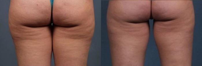 Before & After CoolSculpting Case 658 Back View in Louisville, KY