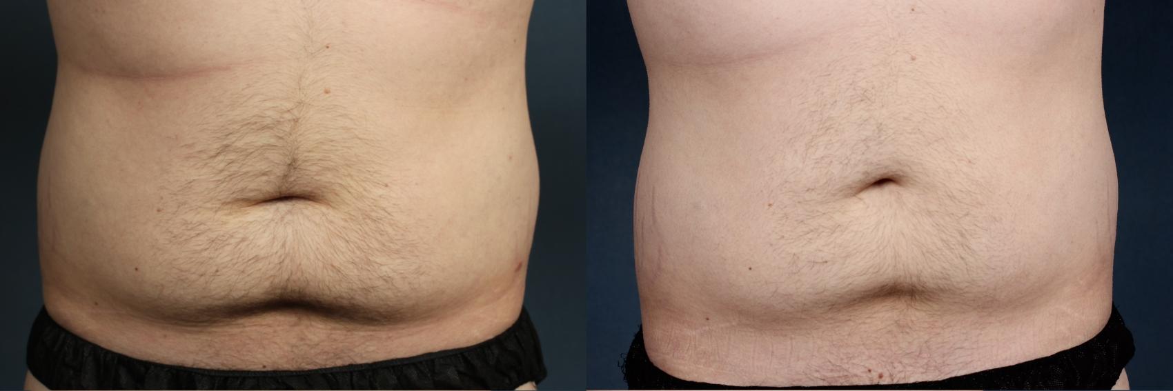 Before & After CoolSculpting Case 659 Front View in Louisville & Lexington, KY