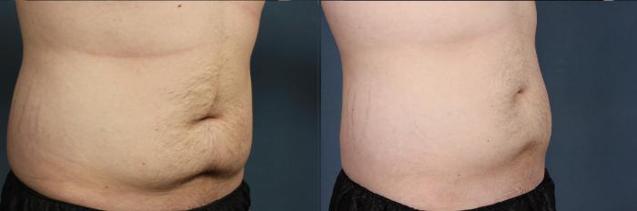 Before & After CoolSculpting Case 659 Right Oblique View in Louisville & Lexington, KY