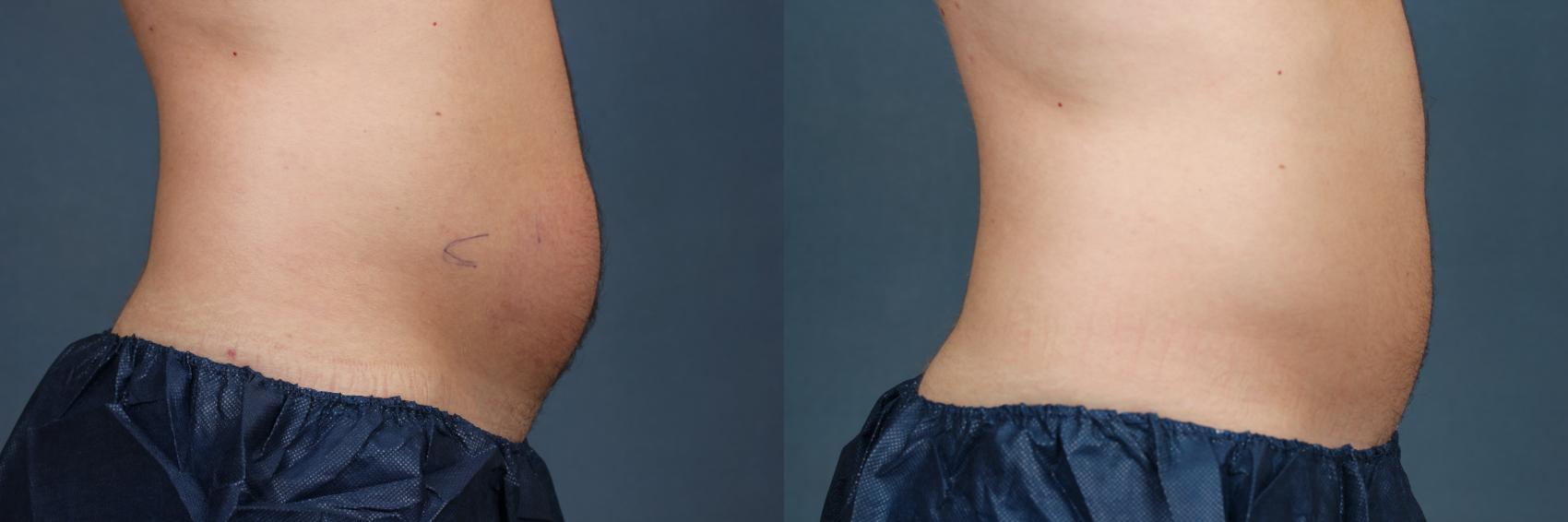 Before & After CoolSculpting Case 661 Right Side View in Louisville, KY