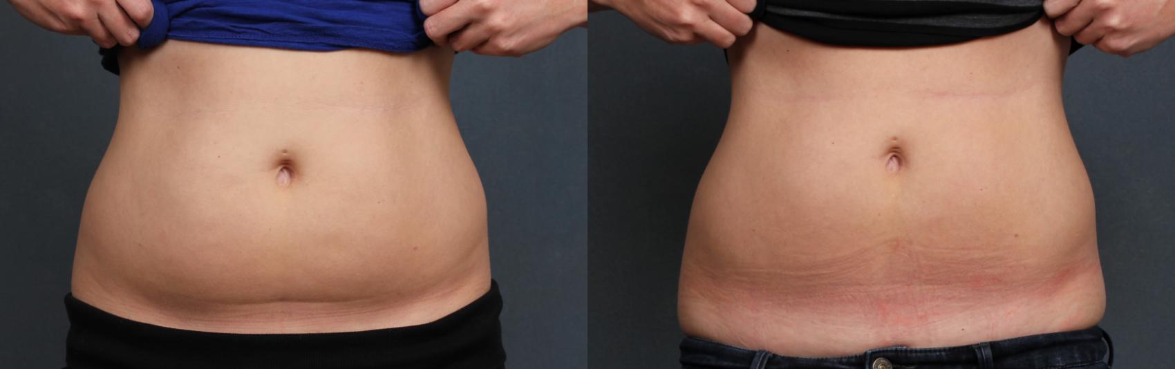 Before & After CoolSculpting Case 664 Front View in Louisville & Lexington, KY