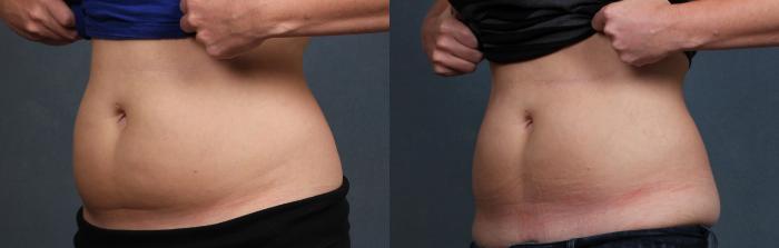 Before & After CoolSculpting Case 664 Right Oblique View in Louisville & Lexington, KY