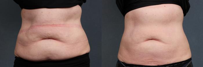 Before & After CoolSculpting Case 666 Front View in Louisville, KY