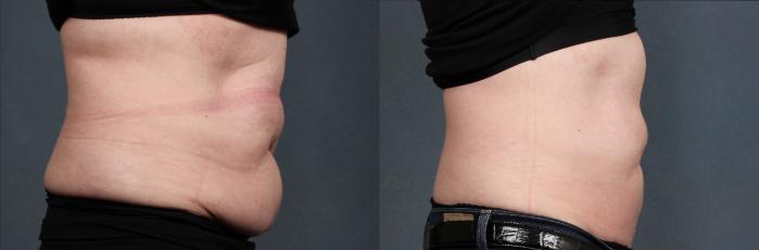 Before & After CoolSculpting Case 666 Right Side View in Louisville & Lexington, KY